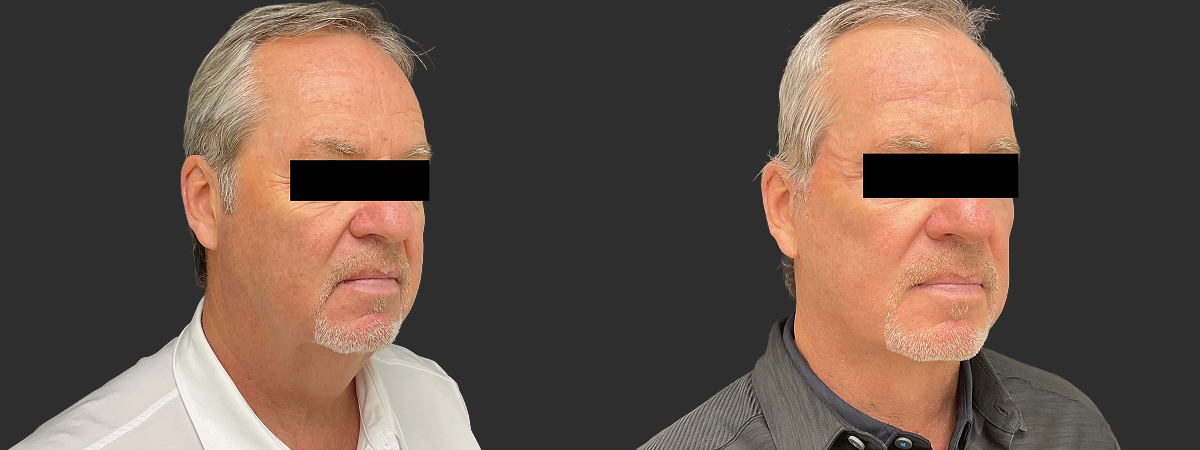 Before and after facelift and neck lift, right oblique view – male patient