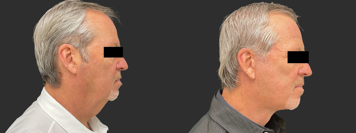 Before and after facelift and neck lift, right side view – male patient