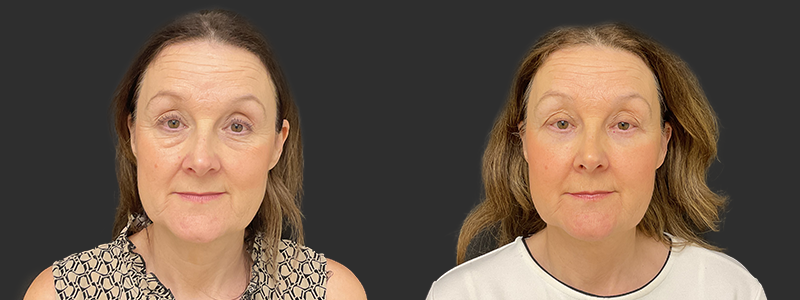 Blepharoplasty results, front view – case 25
