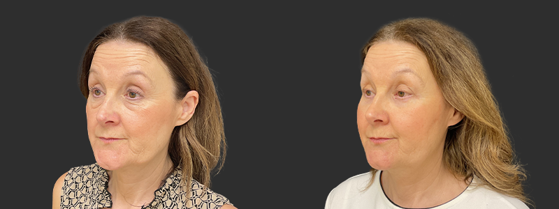 Blepharoplasty results, left angle view – case 25