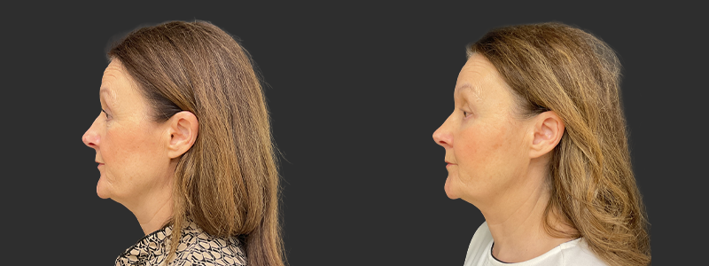 Blepharoplasty results, left profile view – case 25