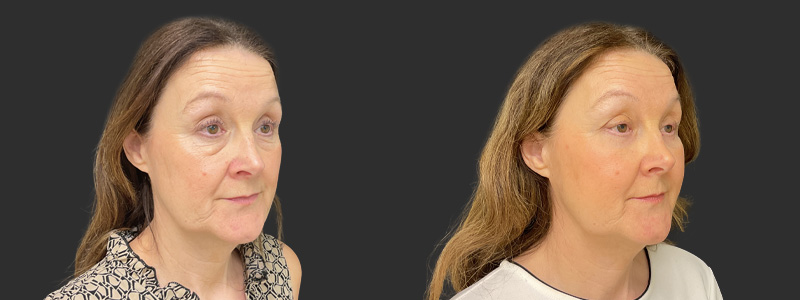 Blepharoplasty results, right angle view – case 25