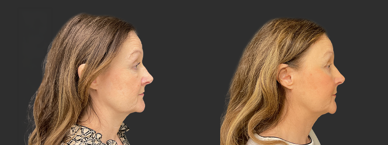 Blepharoplasty results, right profile view – case 25