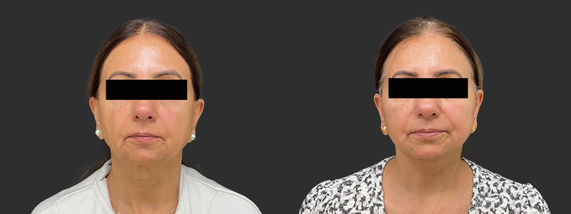 Facelift & necklift results, front view – case 12