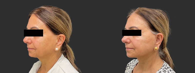 Facelift & necklift results, left angle view – case 12