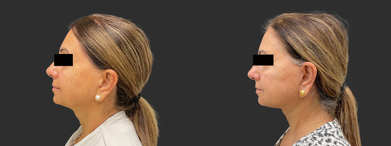 Facelift & necklift results, left profile view – case 12