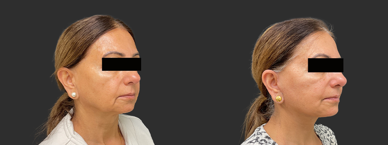 Facelift & necklift results, right angle view – case 12