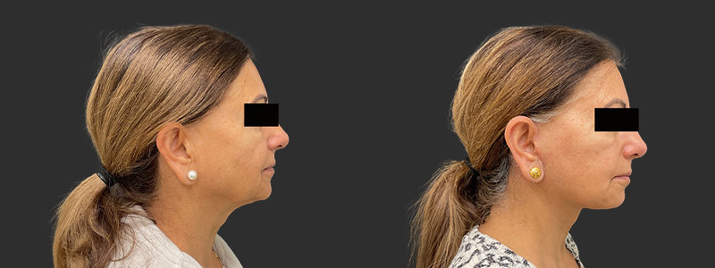 Facelift & necklift results, right profile view – case 12