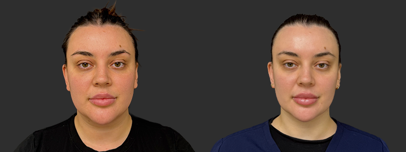 Neck lift results, front view – case 7