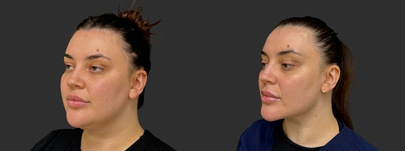 Neck lift results, left angle view – case 7, photo 2