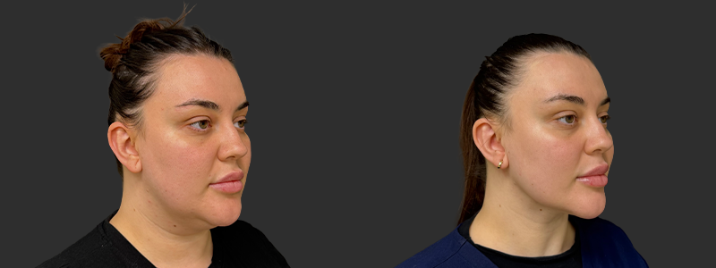 Neck lift results, left angle view – case 7, photo 1