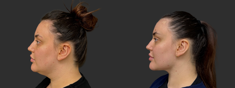 Neck lift results, left profile view – case 7