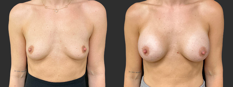 Breast augmentation results, front view – case 89