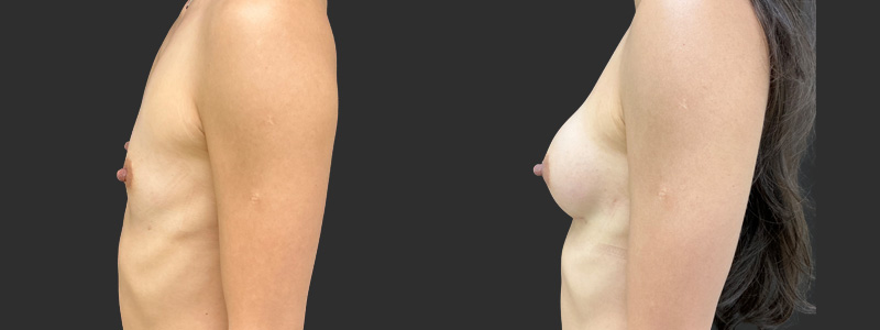Breast augmentation results, profile view – case 90
