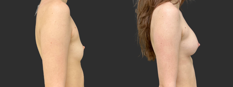 Breast augmentation results, profile view – case 91