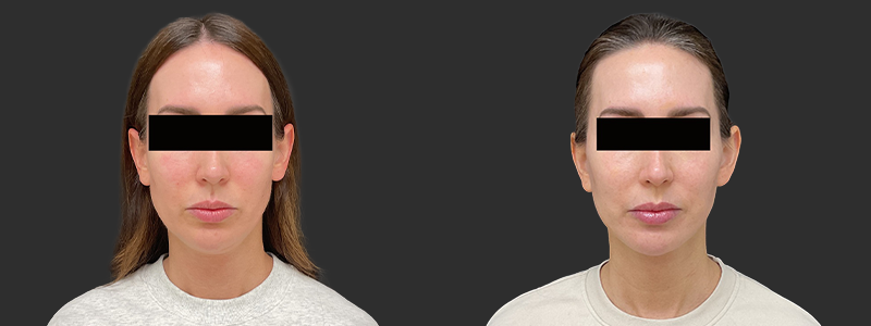 Facelift & necklift results, front view – case 11