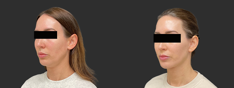 Facelift & necklift results, left angle view – case 11