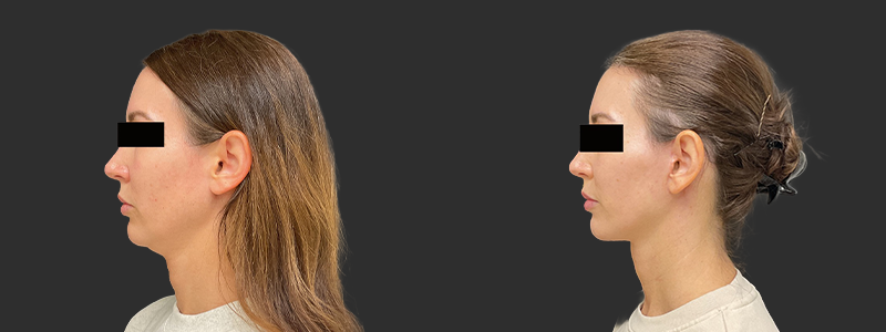 Facelift & necklift results, left profile view – case 11