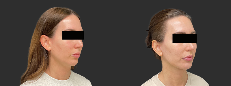 Facelift & necklift results, right angle view – case 11