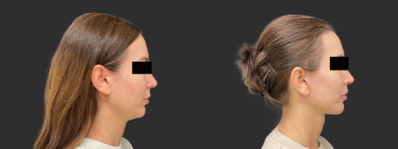 Facelift & necklift results, right profile view – case 11