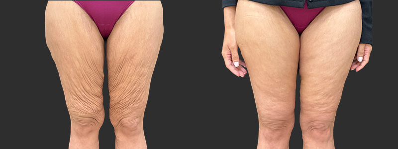 Thigh lift results, front view – case 5