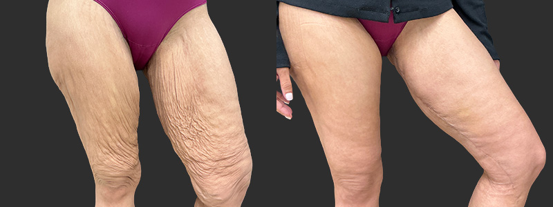 Thigh lift results, open view – case 5