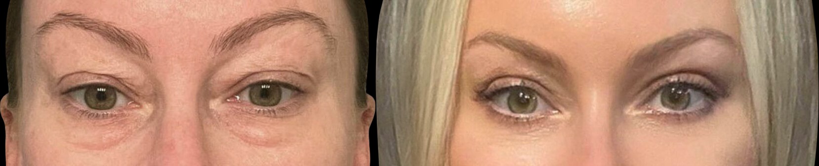 Blepharoplasty results – case 7, photo 1