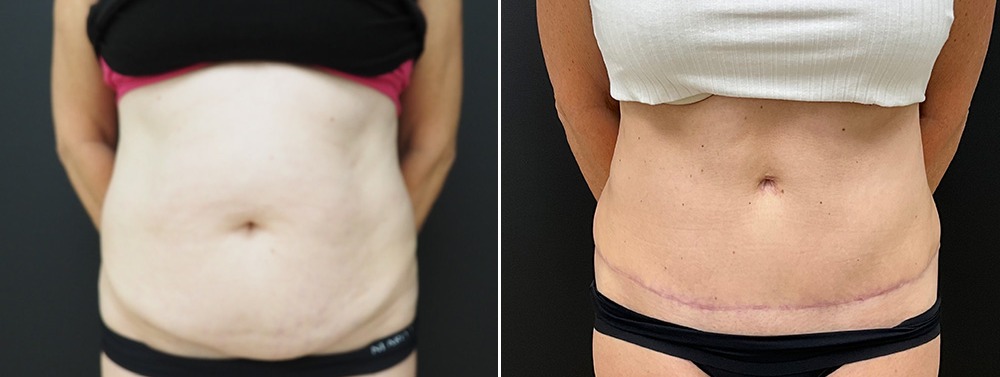 Abdominoplasty / tummy tuck results, front view – case 27
