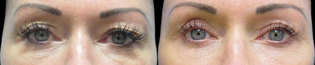 Blepharoplasty results – case 5, photo 1