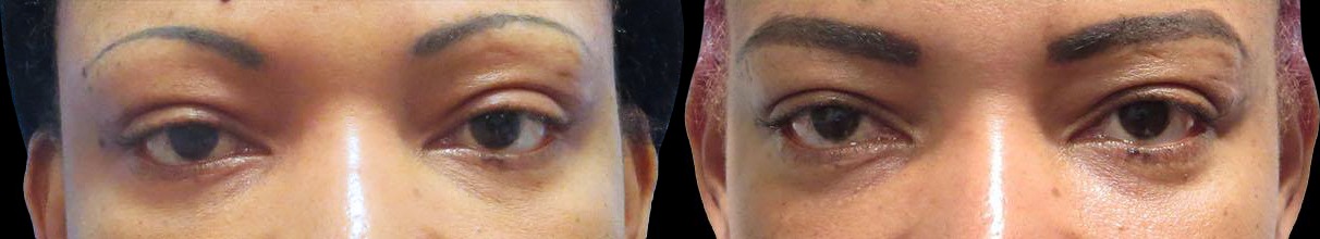 Blepharoplasty results – case 4, photo 1