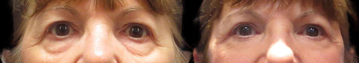 Blepharoplasty results – case 3, photo 1