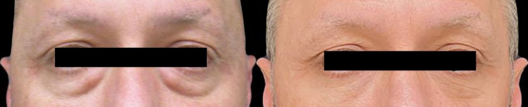 Blepharoplasty results – case 2, photo 1