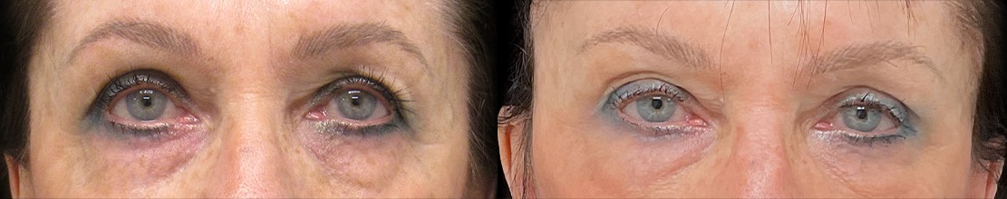 Blepharoplasty results – case 1, photo 1