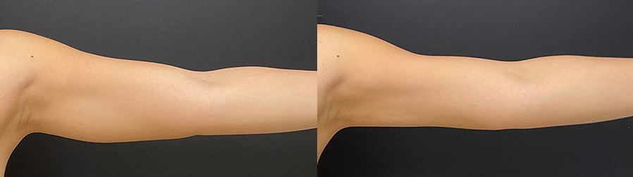 Arm lift results – case 7, photo 4