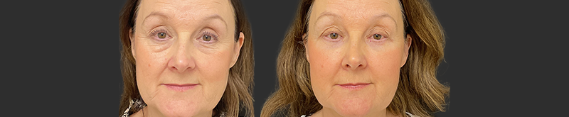 Blepharoplasty results, front view – case 25