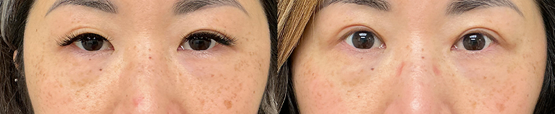 Blepharoplasty results – case 17