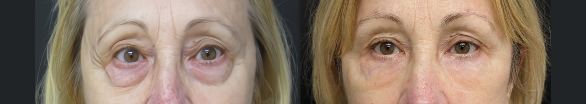 Blepharoplasty results – case 22, photo 3