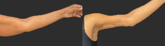 Arm lift results – case 9, photo 1
