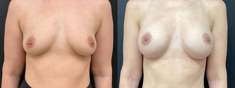 Breast augmentation results, front view – case 31