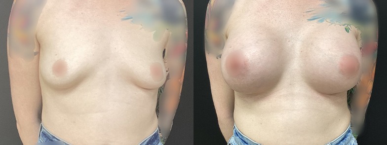 Breast augmentation results, front view – case 23