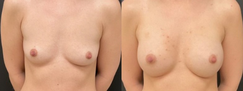 Breast augmentation results, front view – case 24