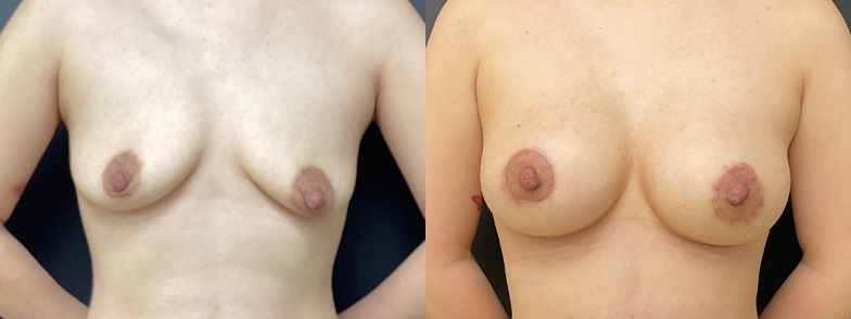 Breast augmentation results, front view – case 18