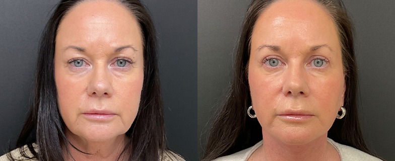 Facelift results, front view – case 5