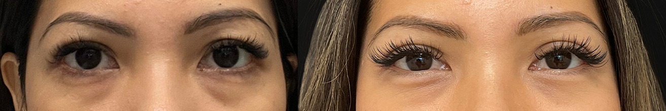 Blepharoplasty results – case 19, photo 3