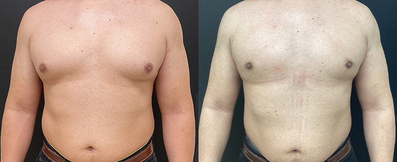 Gynecomastia results – case 10