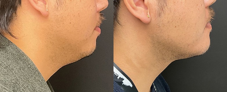Liposuction results – case 1
