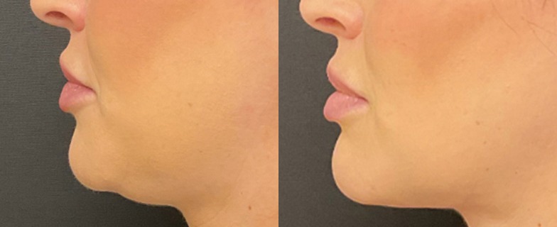 Liposuction and facetite results, profile view – case 1