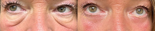 Blepharoplasty results – case 12