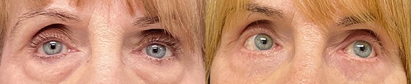 Before and after lower blepharoplasty results – case 4