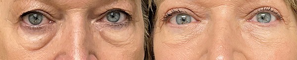 Blepharoplasty results – case 9